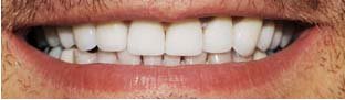 The Hidden Costs of Avoiding the Dentist in Your 30s