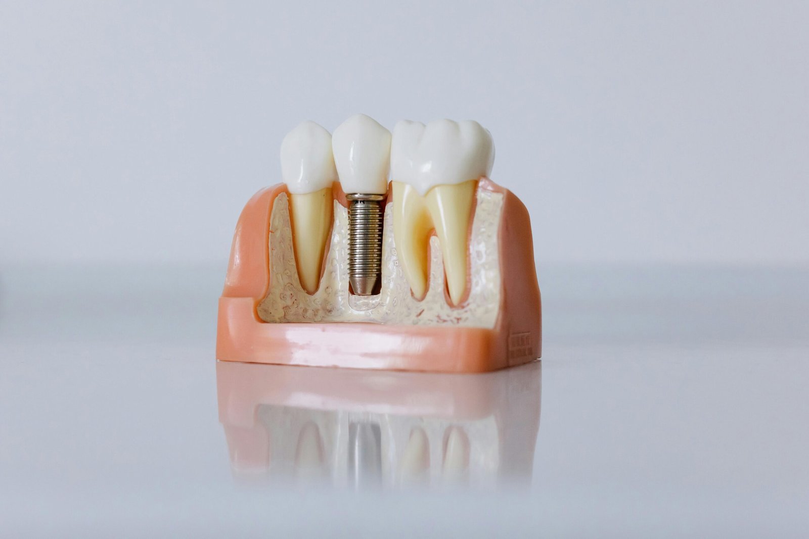 Dental Implant Kingsway: Local Vancouver Cost Guide 2025