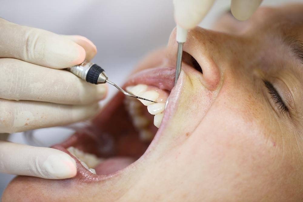 Gum recession treatment consultation in Vancouver dental clinic
