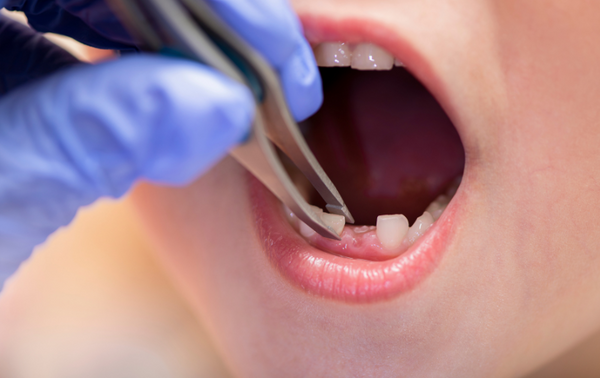 Adult with loose tooth seeking dental treatment in Vancouver