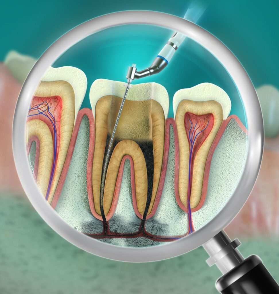 Root canal vs tooth extraction comparison in Vancouver dental clinic