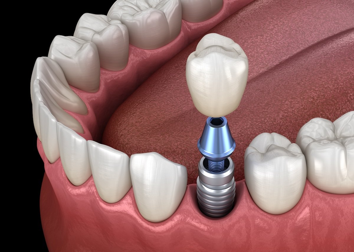 Dental implants in Vancouver